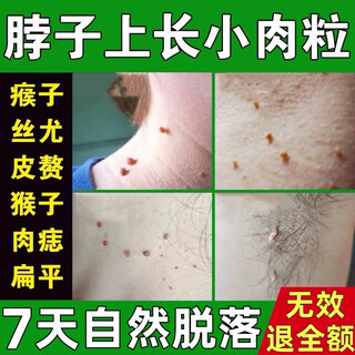 Wart 100% ointment medicine special for small pimples on neck, neck redness, silky armpit wart removal ointment, trial pack, local/fading/special tablets, one box
