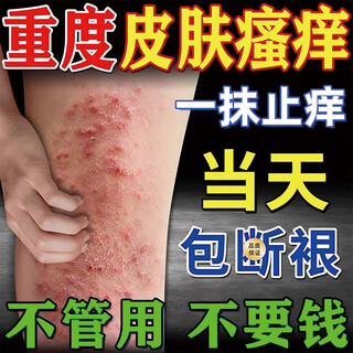 Nippon chemical 3 seconds to relieve itching japan imported calamine anti-itch ointment for dry skin and anti-itch moisturizing lotion for the whole body 1 bottle 3 seconds to relieve itching