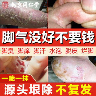 Tongrentang athlete's foot spray anti-itching peeling feet sweat blisters itchy feet smelly sweat spray wolfsbane spray 60ml + ointment 20g