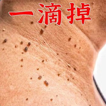 Remove small pimples on the neck, monkey black spots, filamentous thorns, plantar tags, remove flat tags, regular skin tags under the armpits