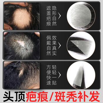 Bell show wig men's head scar replacement piece full real hair scar bald invisible cover scar replacement diameter 3*3cm biological scalp