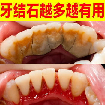 Hong kong pharmacy dental calculus dissolving liquid teeth cleaning and yellowing calculus remover tartar calculus removal powerful mouthwash 1 bottle quickly improves tartar