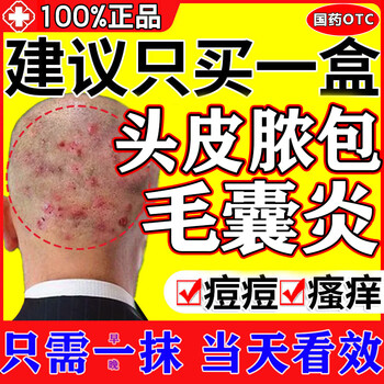 Genuine scalp ringworm, ringworm, itching, dandruff, multi-treatment shampoo, folliculitis, head special medicine, scalp pimples, repeated scabs, red pimples, acne, seborrheic dermatitis, clotrimazole cream 1 tube, medical skin medication, folliculitis, fungal infection, fast delivery