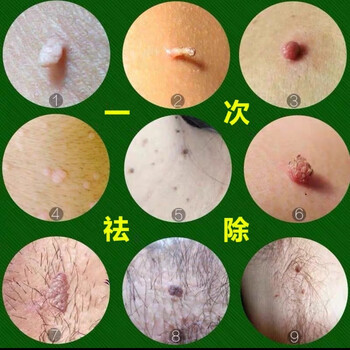 Xinlang plana warts, filiform warts, common warts, neck and armpit fleshy balls can be removed in one go without leaving any traces on the same day. read the instructions carefully + online guidance, 5.m