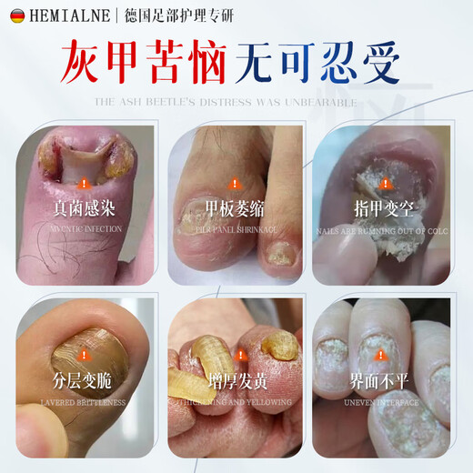 HEMIALNE German onychomycosis special effect medicine for thickening, yellowing, thickening and empty nails fungal infection onychomycosis 1 box of effective medicine 100% special effect for onychomycosis