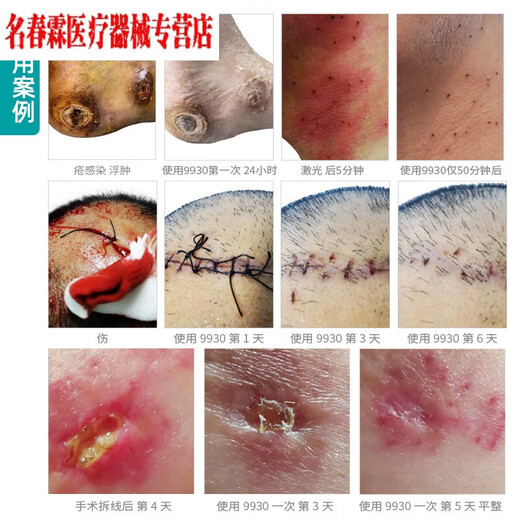 9930医用伤口消毒液烧伤烫伤创伤手术伤家用非酒精消毒防感染喷雾 老款