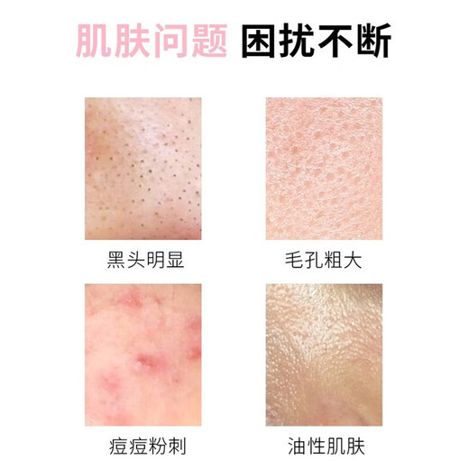 Wing Yan Azelaic Acid 15% Gel Salicylic Acid Pore Refinement Cream Ointment Acne Clearing Gel Blackhead Cream 30g 1 set