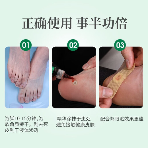 Chunchuntang Yunnan Herbal Corns Patch Hands and Feet Removes Warts, Plantars, Heels, Pads, Calluses, Thorns Monkey's Corns Cream
