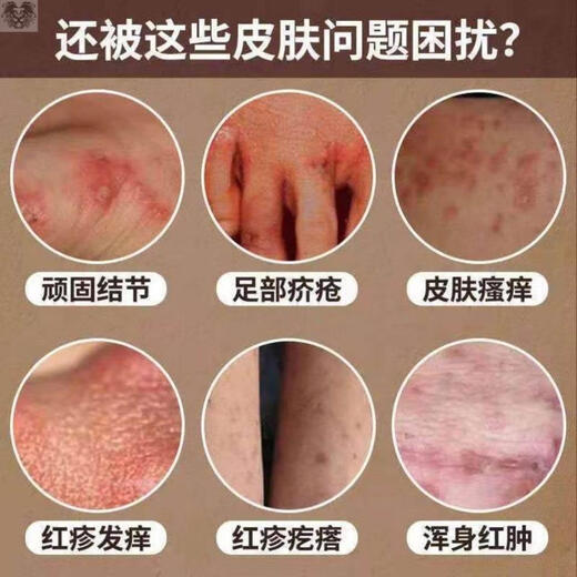 Shiduqing ointment anti-pruritic ointment for skin itching, dermatitis, red rash, small red pimples, systemic neurogenic dry eczema, a box