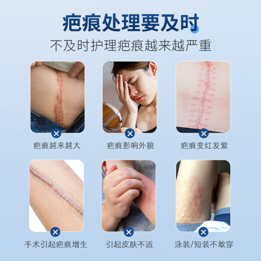 HIEUAILR medical scar removal cream, scar scar removal cream, special scalpel injury, fall, burn, caesarean section, double eyelid facial hyperplasia repair, scar removal, imported silicone scar removal gel