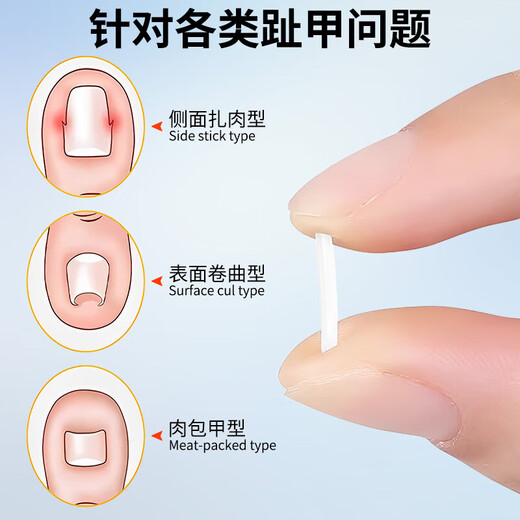 Xiangyitang paronychia correction 50 tablets * 1 toenail correction and repair device isolation filling pad for long toenails