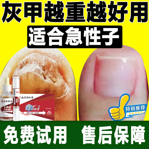 Nanjing Tongrentang onychomycosis special antibacterial liquid onychomycosis set 35g