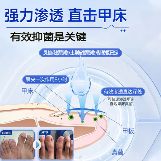 Nanjing Tongrentang onychomycosis special antibacterial liquid onychomycosis set 35g