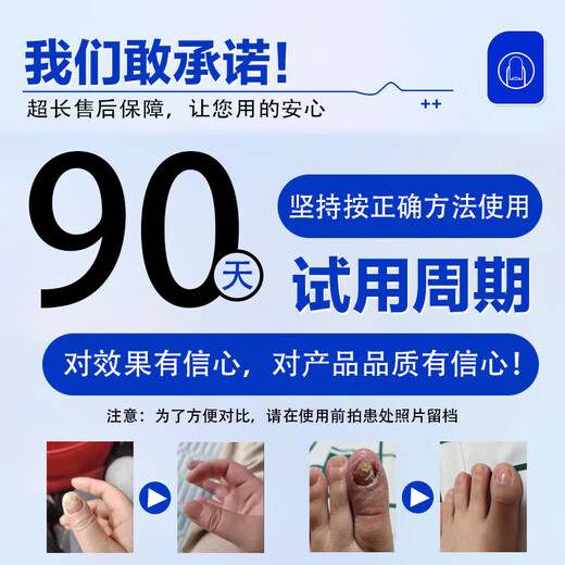 Nanjing Tongrentang onychomycosis special antibacterial liquid onychomycosis set 35g