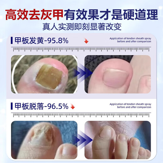 Nanjing Tongrentang onychomycosis special antibacterial liquid onychomycosis set 35g