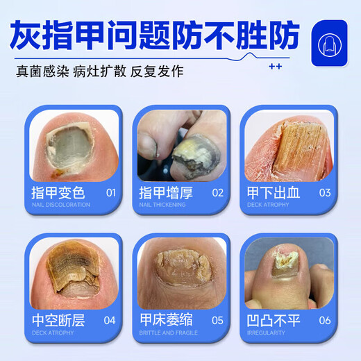 Nanjing Tongrentang onychomycosis special antibacterial liquid onychomycosis set 35g