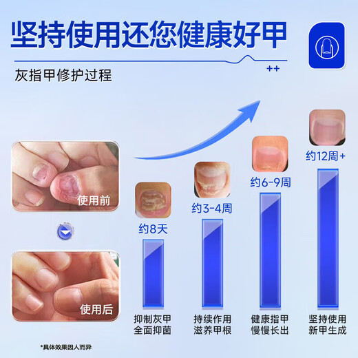 Nanjing Tongrentang onychomycosis special antibacterial liquid onychomycosis set 35g
