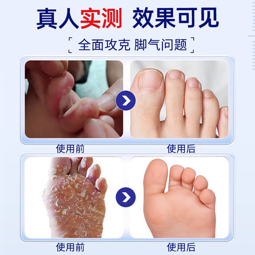 VKR Powerful Fungus King Athlete's Foot Cream Fungus Infected Feet Peeling, Erosion, Blisters, Sore Feet, Sweaty Feet, Odorful Feet Itching. Buy 2 shots and 3 boxes to eradicate the roots. Only spend 2 boxes.