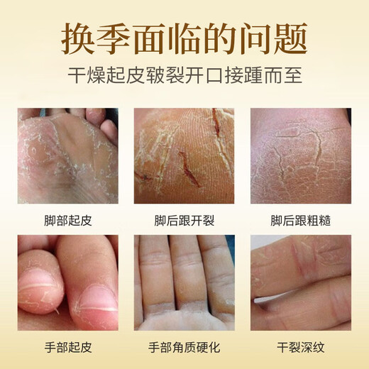 Xiting Horse Oil Anti-Crack Cream for Dry Hands and Feet, Cracked Hands and Heels, Rough Moisturizing Moisturizing Cream 50g 2 Bottles Horse Oil Anti-Crack Hand and Foot Cream