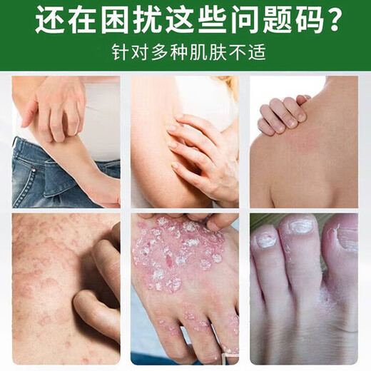 Qinyitang Huang's Fungus King Antibacterial Cream Astragalus Wang's Zhenyin King Cream Old Style Huangpi Ointment Official Authentic 1 Stick (Official Authentic Fungus King) 23g/stick