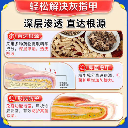 Special effects on onychomycosis. Nail thickening, yellowing, thickening and emptying. Fungal infection. Imported from Japan. Buy 2 shots of 3. 99w. The patient is fully cured. Recommended by doctors. What medicine is good for onychomycosis in Jingdong store? Quick onychomycosis special large ointment room