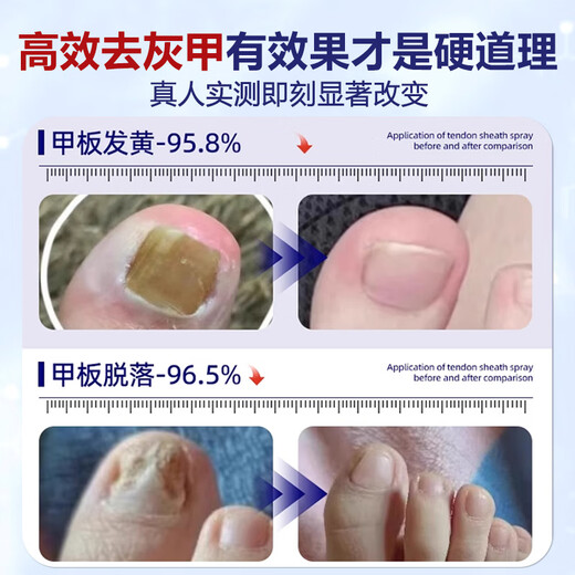 Dr. Xin's Onychomycosis Specially Used for Severe Nail Infections to Remove Onychomycosis, Yellowing and Thickening Liquid Root Cream 30ml