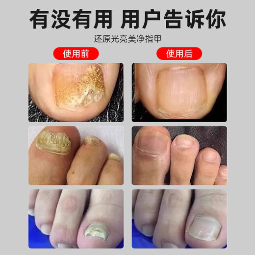 Mattai Tong onychomycosis grinder electric nail grinder manicure nail remover thick nail trimmer automatic nail removal tool