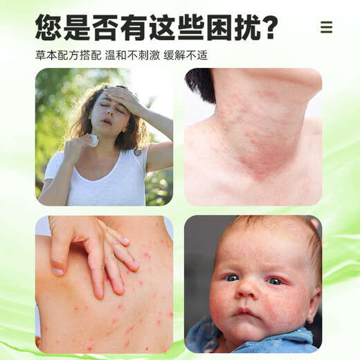 Nobiff Calamine Body Lotion with Calamine Prickly Heat Powder Lotion Spray Protective Soothing Balm 30ml