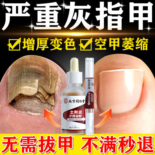 Nanjing Tongrentang onychomycosis special antibacterial liquid onychomycosis set 35g