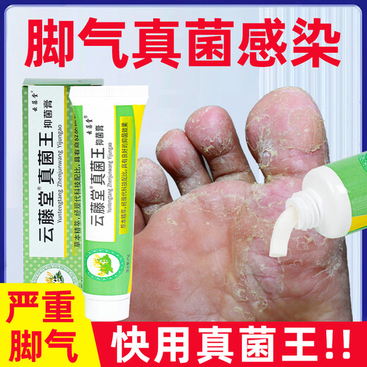 VKR Powerful Fungus King Athlete's Foot Cream Fungus Infected Feet Peeling, Erosion, Blisters, Sore Feet, Sweaty Feet, Odorful Feet Itching. Buy 2 shots and 3 boxes to eradicate the roots. Only spend 2 boxes.