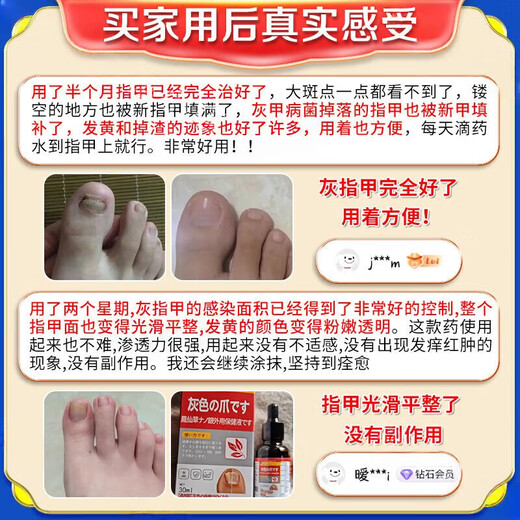 Special effects on onychomycosis. Nail thickening, yellowing, thickening and emptying. Fungal infection. Imported from Japan. Buy 2 shots of 3. 99w. The patient is fully cured. Recommended by doctors. What medicine is good for onychomycosis in Jingdong store? Quick onychomycosis special large ointment room