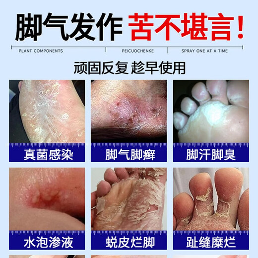 VKR Japanese athlete's foot anti-itching peeling sterilization fungal infection special rotten feet smelly feet itchy erosion Wolfsbane athlete's foot spray buy 2 get 1 free for moderate itchy feet