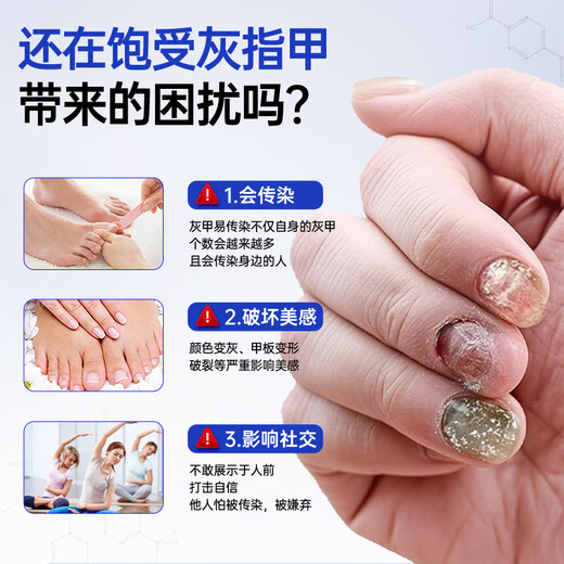 Shibuoka Pharmaceutical Japan's special onychomycosis, severe onychomycosis, yellowing fungal infection, effective non-medicinal removal of onychomycosis*3 boxes