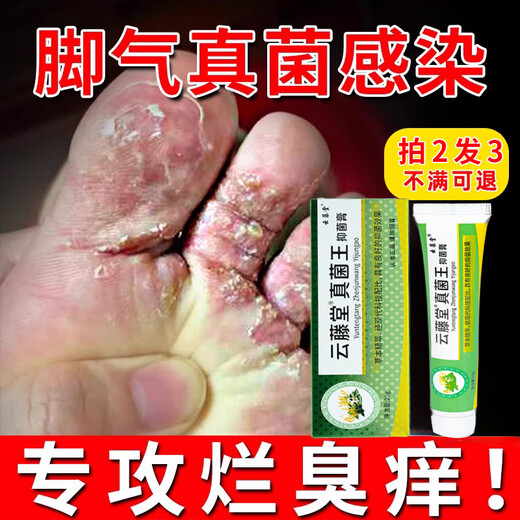 VKR Powerful Fungus King Athlete's Foot Cream Fungus Infected Feet Peeling, Erosion, Blisters, Sore Feet, Sweaty Feet, Odorful Feet Itching. Buy 2 shots and 3 boxes to eradicate the roots. Only spend 2 boxes.