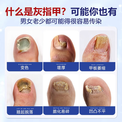 Dr. Xin's Onychomycosis Specially Used for Severe Nail Infections to Remove Onychomycosis, Yellowing and Thickening Liquid Root Cream 30ml