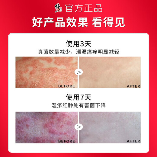 Correct the moist and itchy scrotum, scrotal inflammation, testicular itching, eczema cream, anus and inner thigh skin itching, relieve itching for men. An initial set (double-effect type) for moist and itchy men's private parts, special anti-itching and root removal.