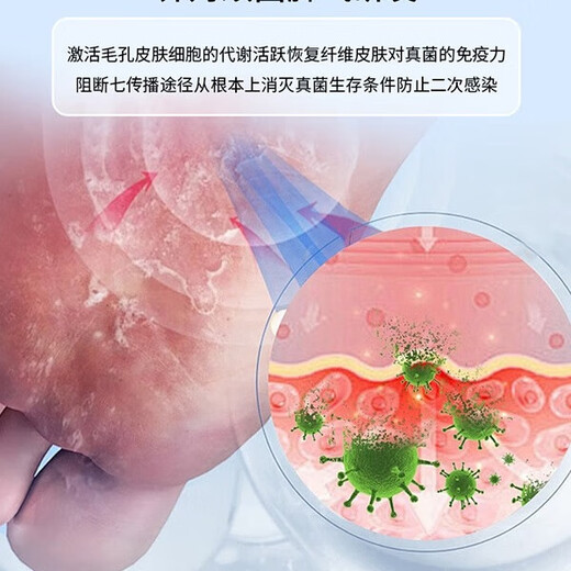 VKR Japanese athlete's foot anti-itching peeling sterilization fungal infection special rotten feet smelly feet itchy erosion Wolfsbane athlete's foot spray buy 2 get 1 free for moderate itchy feet
