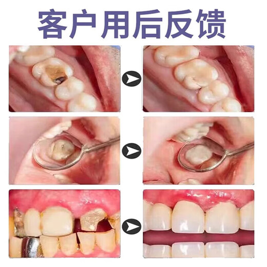 Dental filling artifact, self-filling material, medical 3m American technical resin temporary cavity denture adhesive, buy 2, get 1 free, hot sale, can fill about 12 teeth