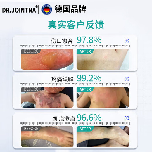 DR.JOINTNA pharmaceutical burns and scalds ointment, redness, swelling and blistering without leaving scars, gel repair ointment, hot oil and boiled water, special non-medicine
