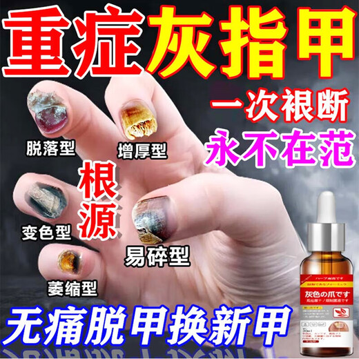 Special effects on onychomycosis. Nail thickening, yellowing, thickening and emptying. Fungal infection. Imported from Japan. Buy 2 shots of 3. 99w. The patient is fully cured. Recommended by doctors. What medicine is good for onychomycosis in Jingdong store? Quick onychomycosis special large ointment room