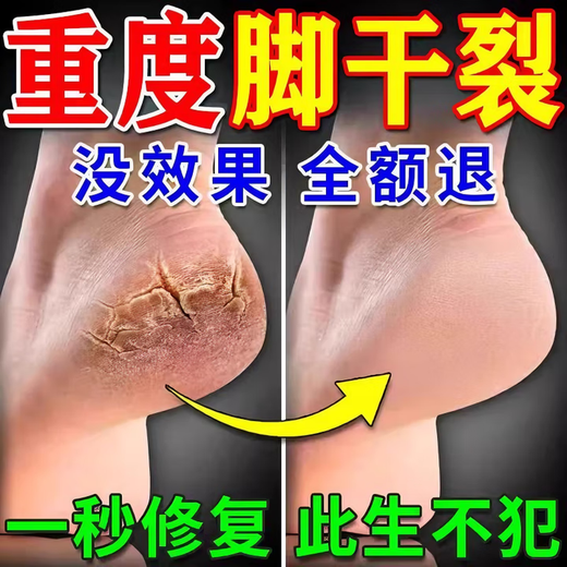 Japanese chemical medicine, 3 seconds healing, cracked foot cream, cracked heels, cracked feet, moisturizing cream, moisturizing hands and feet, preventing cracking and peeling, 1 bottle, 1 second repair