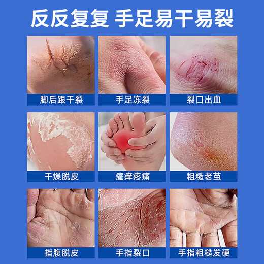 New Xile Cracked Corning genuine anti-cracking ointment Vaseline hand cream to prevent dry cracked hands, feet and heels, non-chilblain cracking and chapped