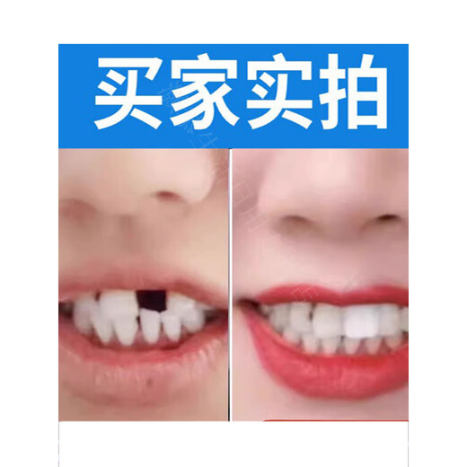 Modou Shenghuo Artefakt-Zahnfüllung zu Hause, Hohlraumpaste, Lückenmaterial, Zahnspangen füllt die Lücken von falschen Zähnen 15 Mal (wird mit Anleitung + Werkzeugset geliefert)