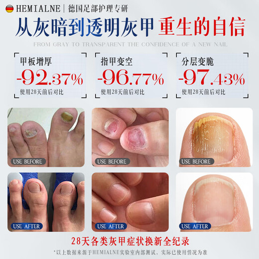 HEMIALNE German onychomycosis special effect medicine for thickening, yellowing, thickening and empty nails fungal infection onychomycosis 1 box of effective medicine 100% special effect for onychomycosis