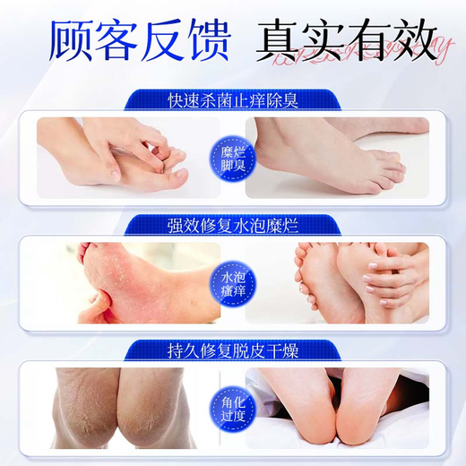 DR.SCT athlete's foot spray can relieve itching, peeling and rotten feet, fungal infection, rotten feet, smelly feet, and itchy feet can be treated with plaster patches