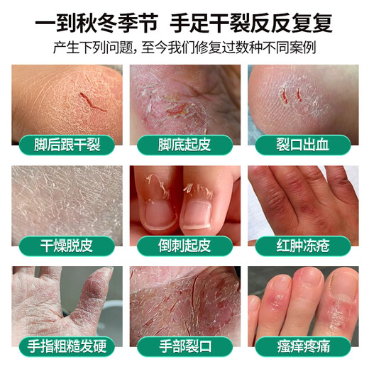 Chunchuntang Heel Cracked, Cracked and Hard Skin Soles, Hands and Feet Peeling Anti-Cracking Cream Anti-Fungal Skin Moisturizing Hand Cream