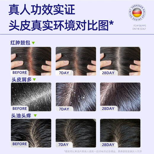 Warrenson Medical Anti-itching, Anti-Dandruff, Folliculitis Shampoo, Scalp Seborrheic Dermatitis Special Fungus Control Drug Administration Certification