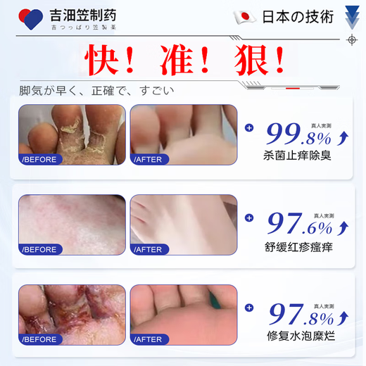 Jilinli Pharmaceutical Japanese athlete's foot spray cream set peeling hands and feet, rotten feet, itchy feet, smelly feet, foot blisters, erosion, skin itching