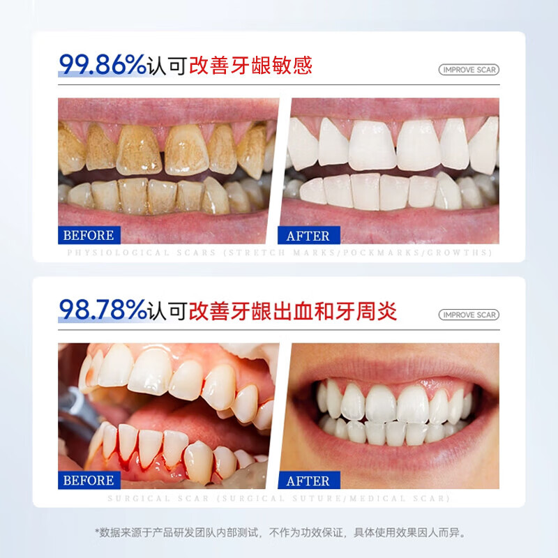 HIEUAILR German special toothpaste for gums, atrophy repair, regeneration, exposed tooth roots, gum protection, tooth fixation, desensitization, top ten well-known brands