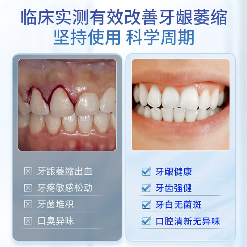 HIEUAILR German special toothpaste for gums, atrophy repair, regeneration, exposed tooth roots, gum protection, tooth fixation, desensitization, top ten well-known brands